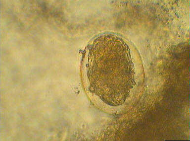 干細胞治療肝硬化及生活飲食